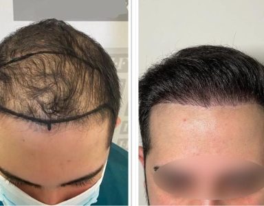 Hair restoration